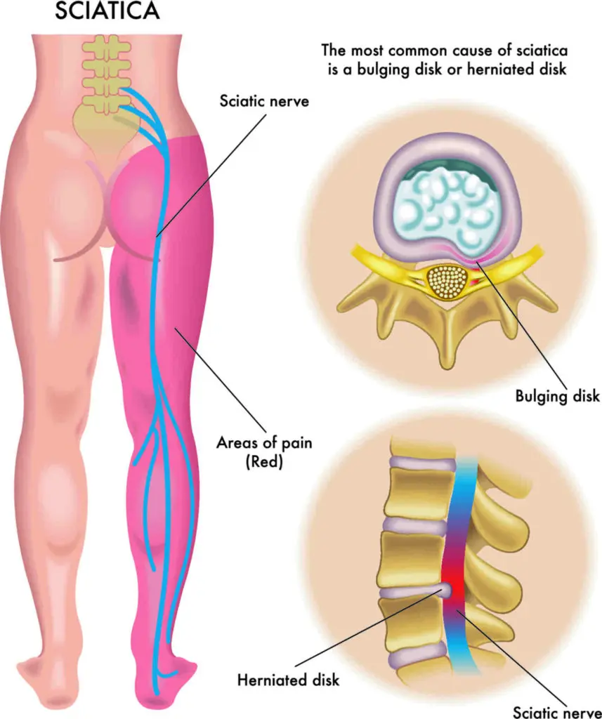 sciatica